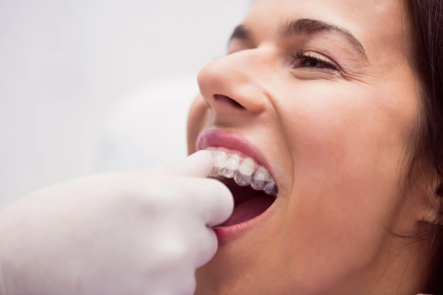 Az Invisalign egy átlátszó fogszabályozó rendszer.