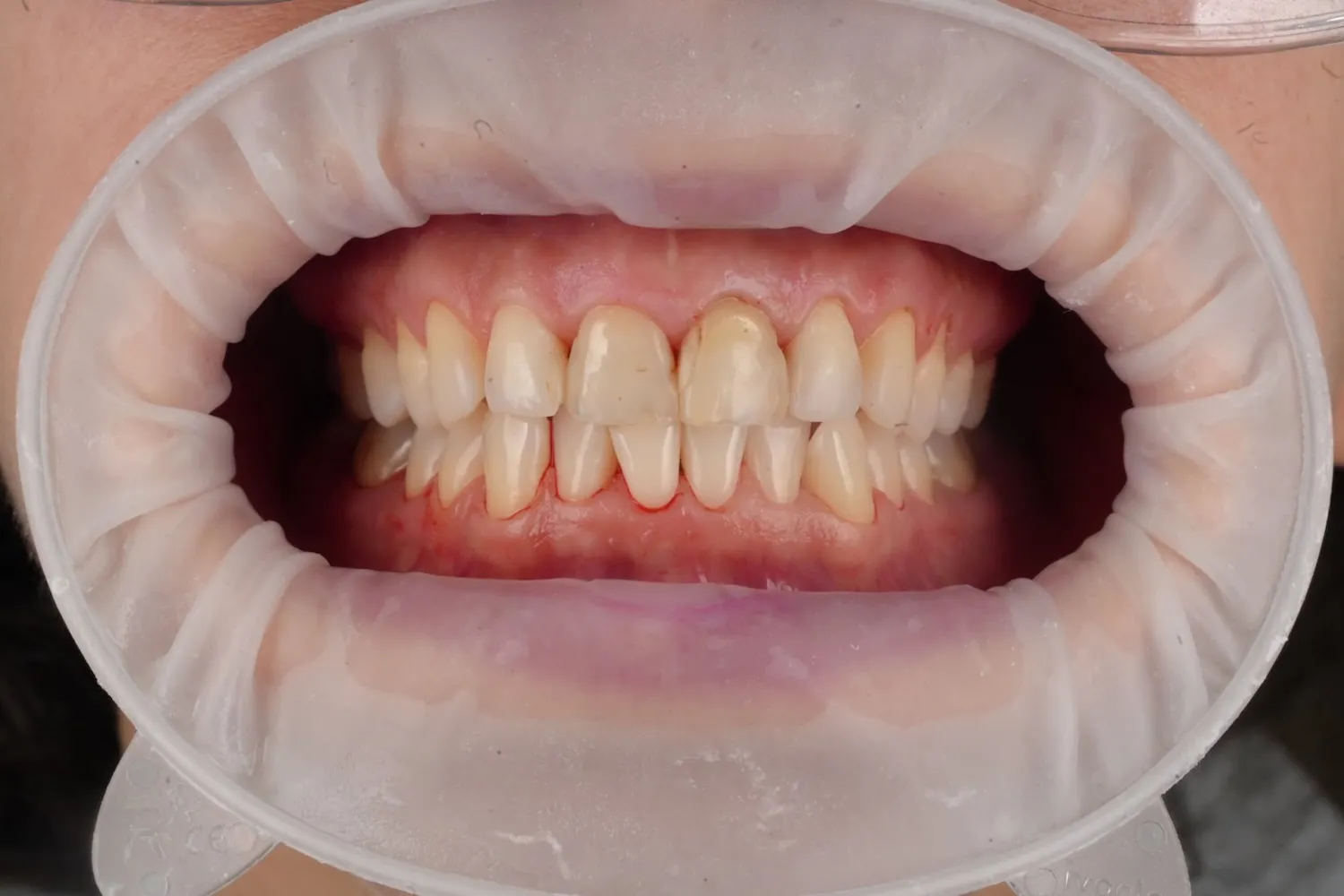 Biofilm terápia után