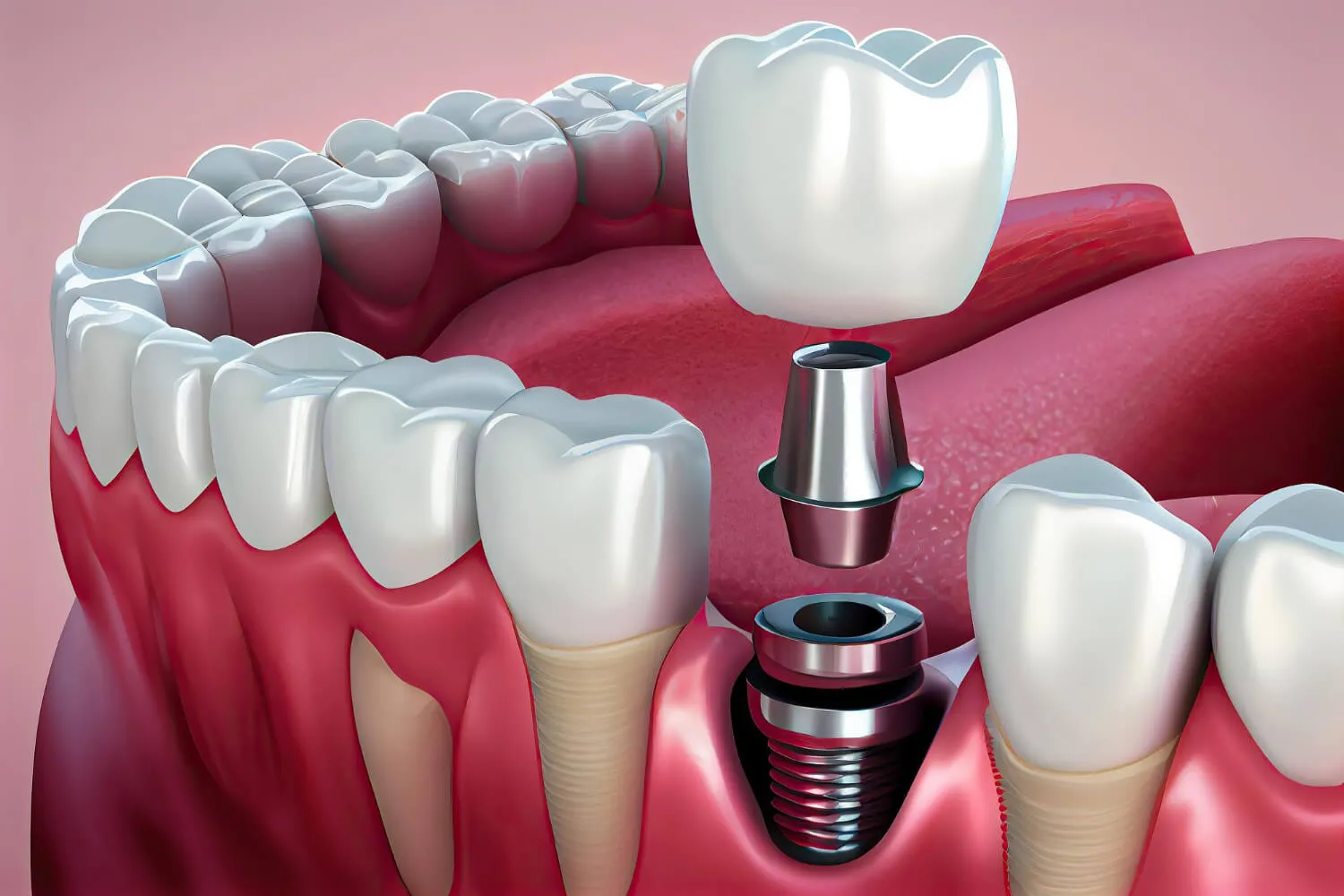 Fogászati implantátum