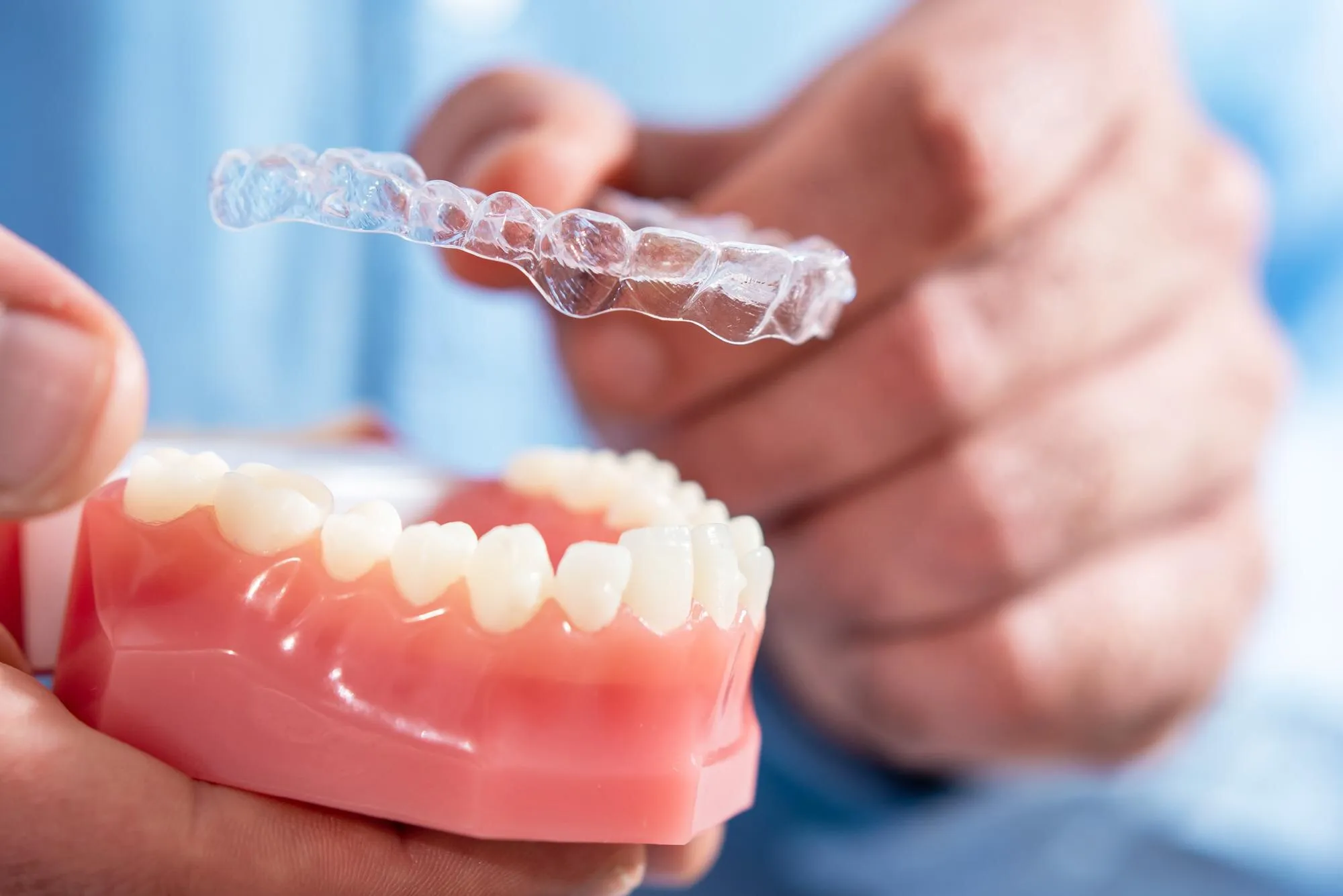 Az Invisalign segítségével a bulldogharapás is korrigálható.