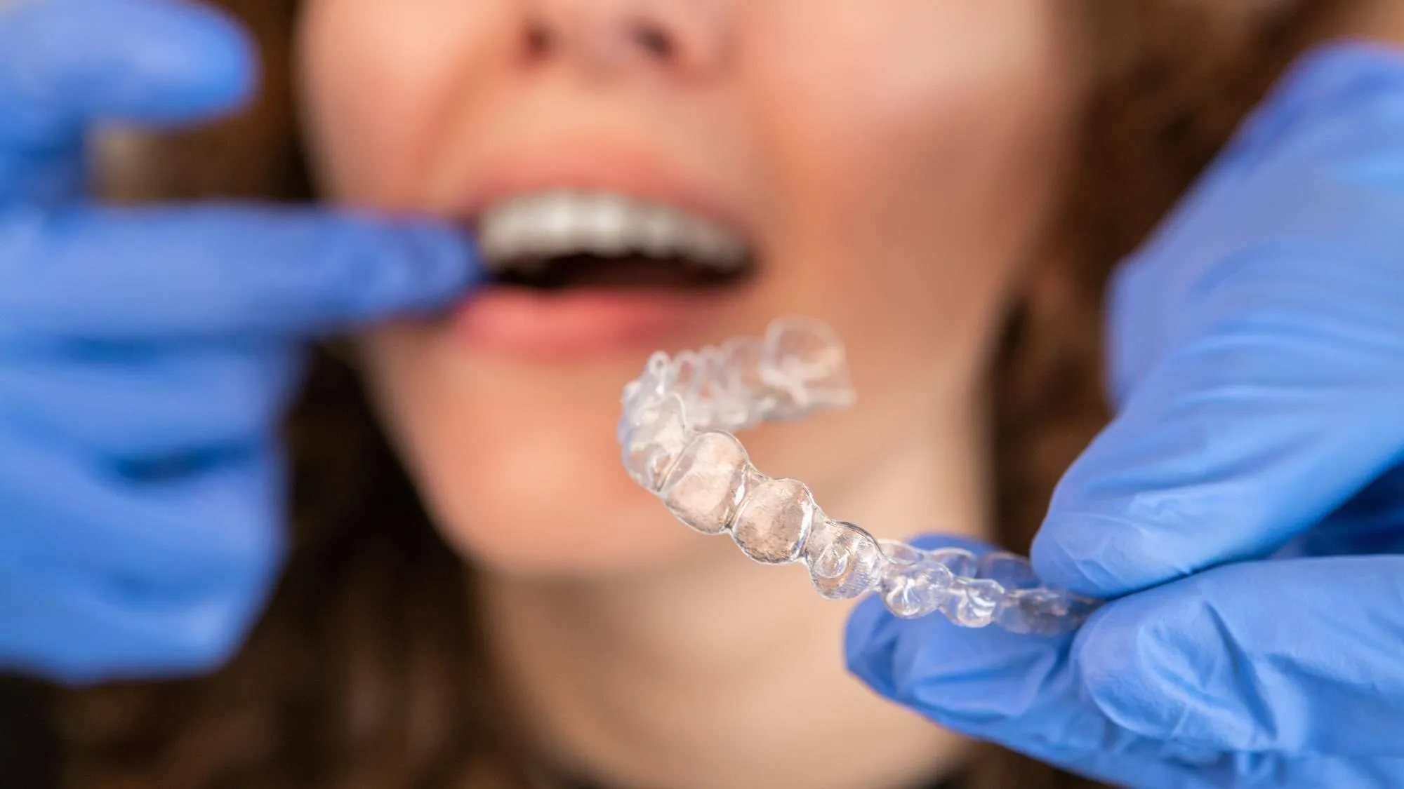 Egy mosolygó női páciensnek mutatják az átlátszó, kivehető Invisalign fogszabályozó sínt.