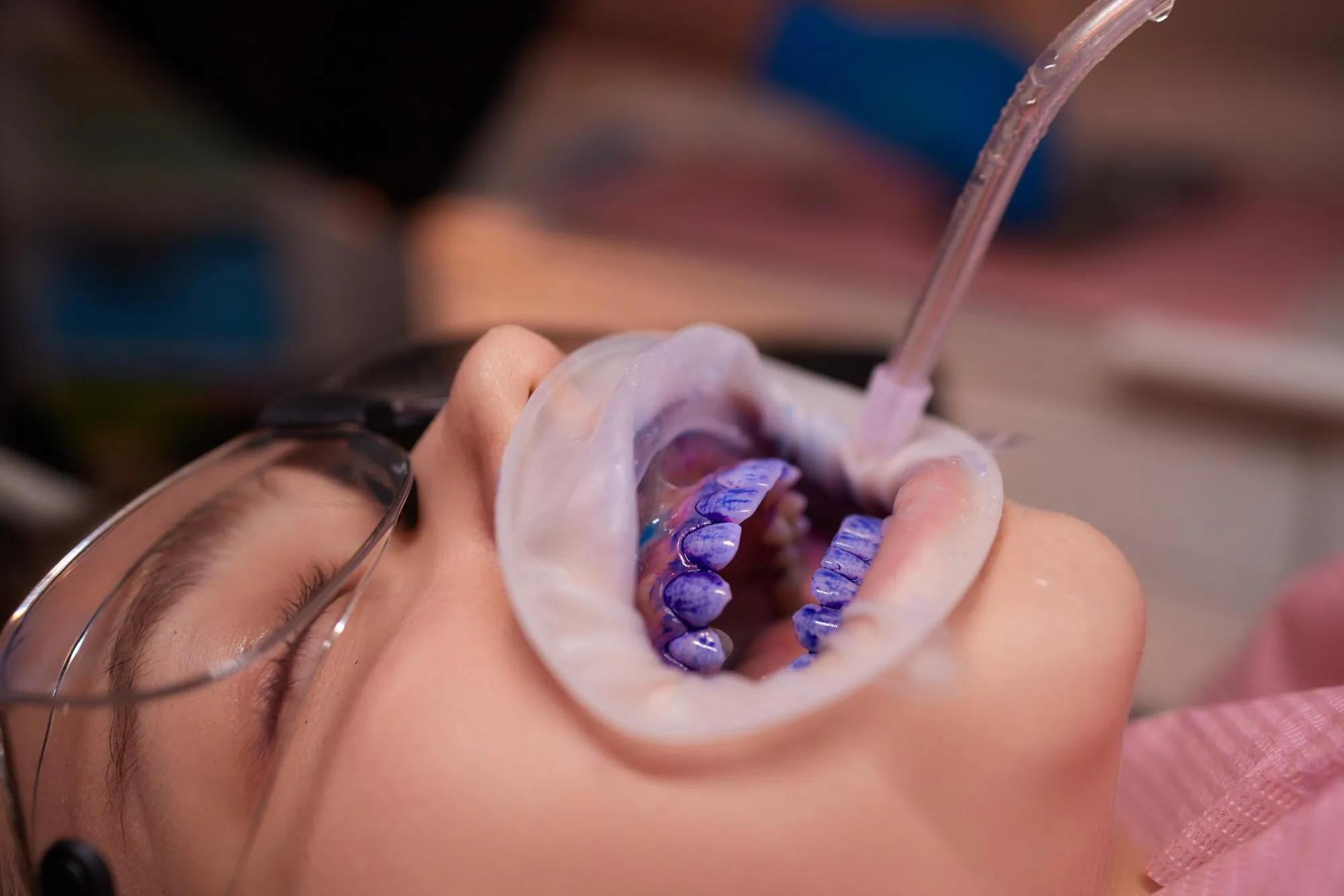 Irányított biofilm terápia fogkő-eltávolításhoz