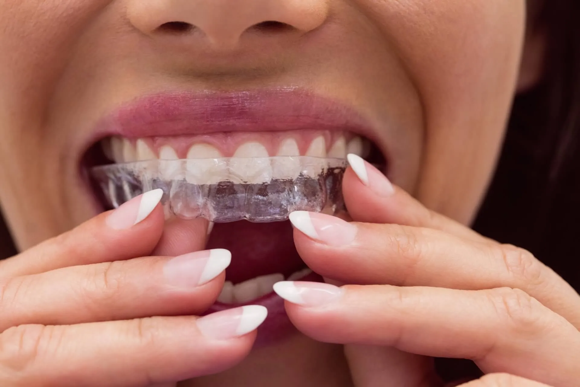 A láthatatlan fogszabályozás felnőttek számára is ideális az Invisalign megoldással.