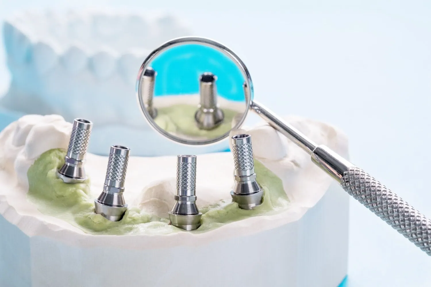 Az All-on-X kezeléskor a beavatkozás napján fix, ideiglenes fogsort kap a páciens.