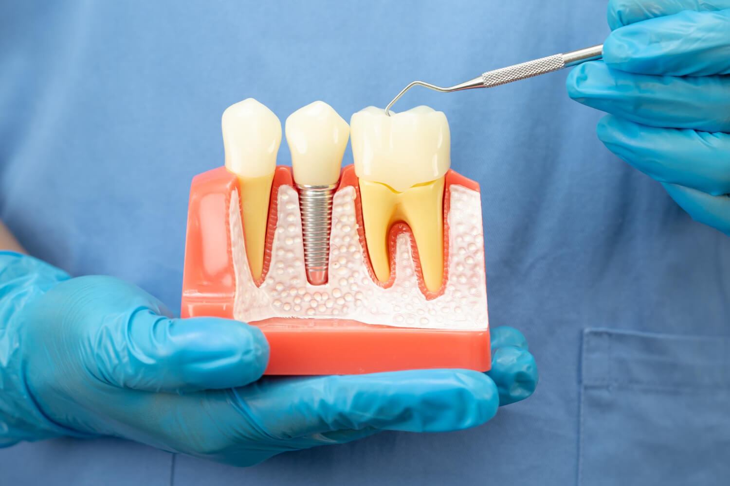 A csontpótlás menetének fontos állomása a megfelelő csontpótló anyag kiválasztása.