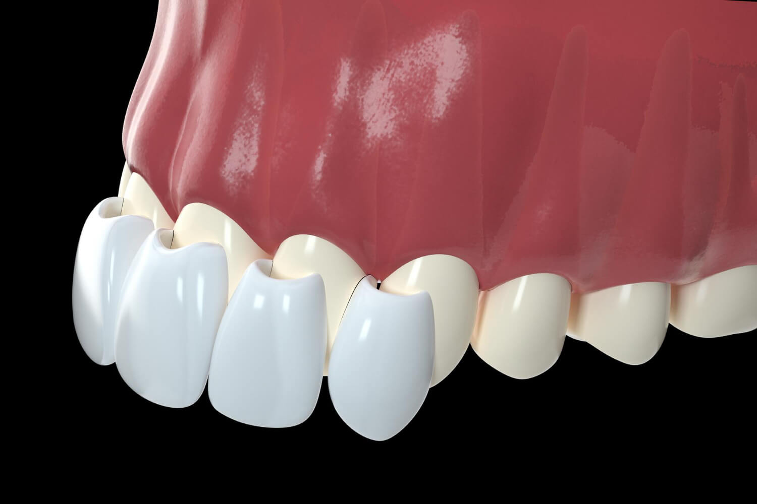 A foghéj csiszolás nélkül lenyomatvétellel és színmeghatározással kezdődik.