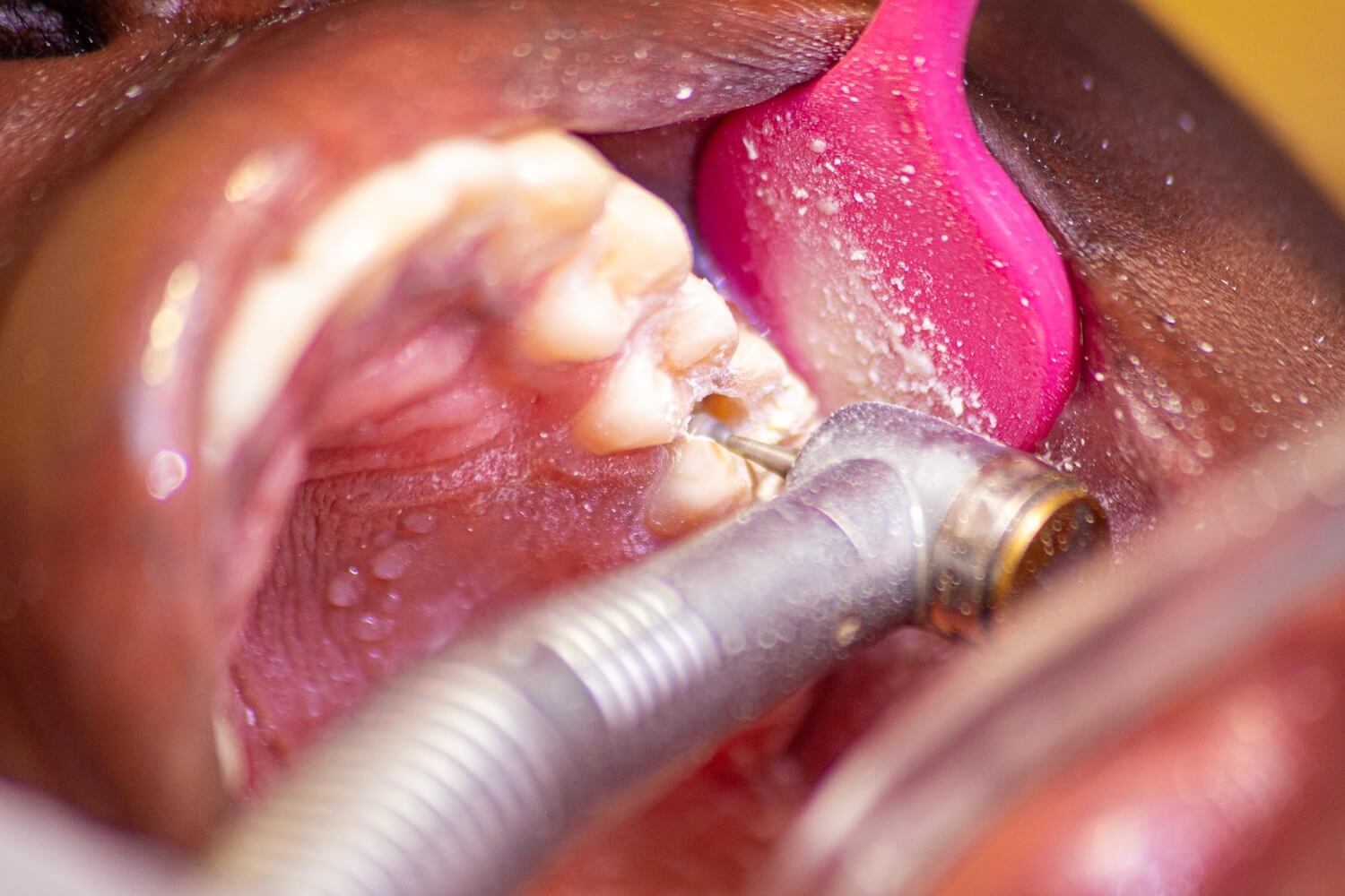 Ha a régi tömött fog fájdalmát tapasztaljuk, indokolt lehet a fogtömés cseréje.