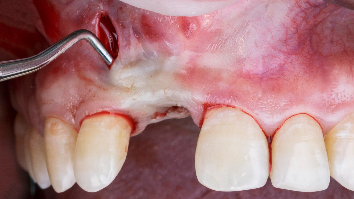 A sinus lift műtét teljes érzéstelenítésben történik.